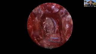 Módulo Neurocirugía de la Base del Cráneo Manejo endoscópico [upl. by Call702]