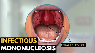 Infectious mononucleosis Causes Signs and Symptoms Diagnosis and Treatment [upl. by Ginder]