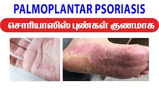 PALMOPLANTAR PSORIASIS சொரியாஸிஸ் புண்கள் குணமாக  Psoriasis Remedy  JKT SKIN psoriasis remedies [upl. by Eigroeg355]