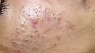 ACNE REMOVAL on Cheeks  Pimple Popping at its Best [upl. by Oelak]