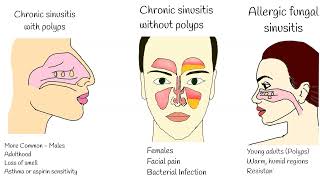 Chronic Sinusitis  Symptoms causes and treatment Sinusitis with polyps Fungal sinusitis [upl. by Claman]