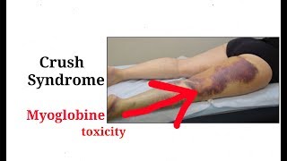 Crush syndrome  rhabdomyolysis  Muscles injuryHindi [upl. by Barbee367]