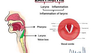 Laryngitis [upl. by Drawd301]