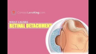 What Causes Retinal Detachment [upl. by Nakashima362]