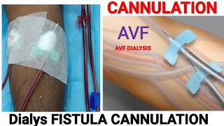 dialysis AVF fistula cannulation video  AVF Cannulation  dialysis Fistula cannulation video [upl. by Tihom]