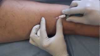 SyrEase Foam Sclerotherapy [upl. by Akela]