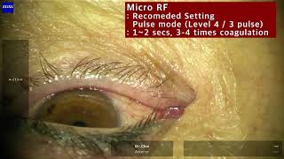 Punctal occlusion using MicroRF in Aqueous Deficiency Dry Eye [upl. by Nirihs]