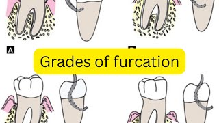 Grades of furcation involvement MADE EASY [upl. by Trevah424]