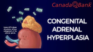 Congenital Adrenal Hyperplasia [upl. by Chen]