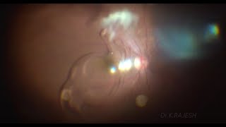 IOL Drop and Sulcus IOL Fixation  Video 120 [upl. by Will]