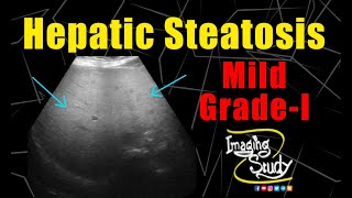 Mild Hepatic Steatosis  GradeI Fatty Liver  Ultrasound  Case 226 [upl. by Ynafetse326]