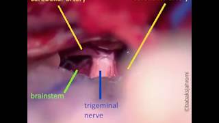 Trigeminal Neuralgia [upl. by Hasile]