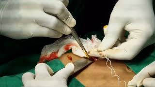 Open Appendectomy  Live surgical video [upl. by Dill158]