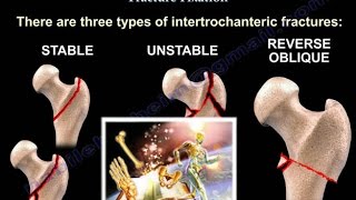 Intertrochanteric Hip Fractures  Everything You Need To Know  Dr Nabil Ebraheim [upl. by Drye533]