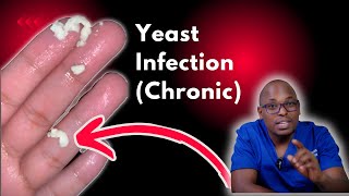 Chronic Yeast Infections  Recurrent yeast Infections  Causes signs and symptoms Treatment [upl. by Ecyar779]