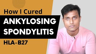 How I Cured My Ankylosing Spondylitis  Ayurvedic Treatment [upl. by Antonino]