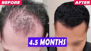 MOST INSANE Finasteride Hair Regrowth You Will See 4 Month Result [upl. by Nyrrat133]