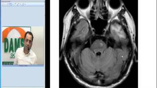 Radiology Spotters by Dr Sumer Sethi 34  Wallerian Degeneration [upl. by Prussian]