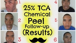 Chemical Peel  25 TCA Peel Followup Results HD  Session 3 [upl. by Pietje]