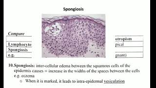 Histopathology 3 👉 acantholysis amp spongiosis amp ballooning [upl. by Leiad]