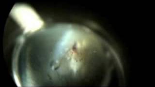 Laser Peripheral Iriditotomy to Prevent Glaucoma Part 2 [upl. by Haimerej]