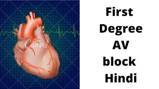 ECG test  ECG kaise karte hai  First degree atrioventricular blockAV block Heart block in hindi [upl. by Notsnarc540]