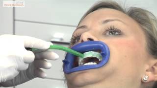 Weiße Zähne durch Bleaching  Zahnaufhellung  Zahnarzt Gundelfingen  Smile Professionals [upl. by Lune]