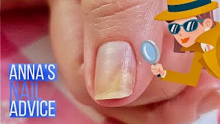 Nail Separation  Causes  Early Treatment of Onycholysis Annas Nail Advice [upl. by Gundry]