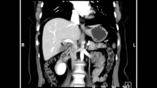 Abdomen Stomach Inferior epigastric arteries 3D Reconstruction for DIEP Block Surgery2 of 2 [upl. by Elyk844]