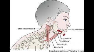 A common cause of TMD Suprahyoid muscle clenching [upl. by Johnnie]