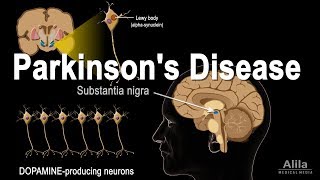 Parkinsons Disease Animation [upl. by Ahsieka]