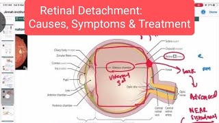 Retinal Detachment Opthalmology 17  First Aid USMLE Step 1 in Hindi [upl. by Gerrald]