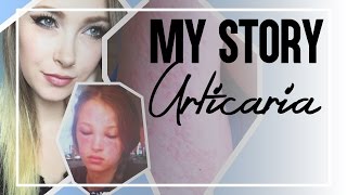 My Story Urticaria Chronic Idiopathic Hives [upl. by Yednarb]