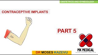 Subdermal implant contraceptives  Part 5 [upl. by Raimes57]