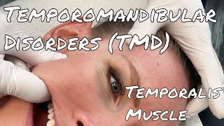 TMJ Pain  Temporalis Release  Motion Specific Release [upl. by Piwowar]