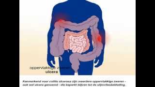 Colitis ulcerosa  Wat zijn de symptomen en behandeling van colitis ulcerosa [upl. by Mandi]