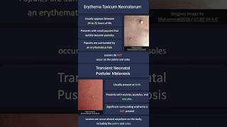 Erythema Toxicum Neonatorum vs Transient Neonatal Pustular Melanosis [upl. by Luca]