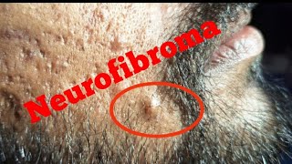 Neurofibroma with heat coutery [upl. by Rome238]