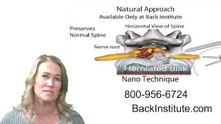 BackInstituteTestimonial NonTraumatic Spine Procedure from Lori [upl. by Bullough]