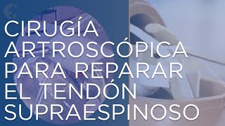 Me he roto el tendón supraespinoso del hombro  Cirugía para reparar el tendón del hombro [upl. by Kristoforo]