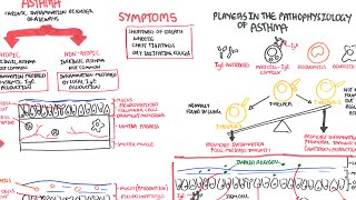 Asthma  signs and symptoms pathophysiology [upl. by Aicxela]