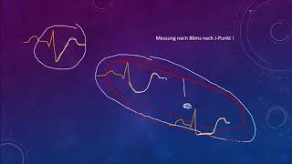 EKG Crashkurs Teil 4 STHebung STSenkung Hypertrophie [upl. by Marinna19]