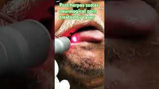 Herpes zoster treated by Laser [upl. by Crista254]