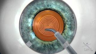 Stephen Slade MD Laser Cataract Surgery Animation [upl. by Annhej]