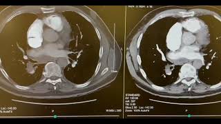 CT Angio Pulmonary Embolism WIth Contrast [upl. by Ayenet]