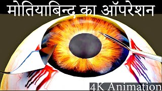 मोतियाबिंद का ऑपरेशन कराने से पहले ये जरूर देख ले। cataract surgery 3d animation [upl. by Simmonds]