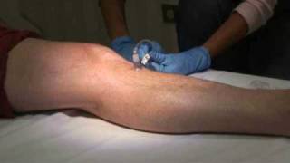 Tibia Identification Lidocaine Infusion Removal [upl. by Inez]