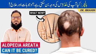 Balchar Ka Ilaj  Causes amp Treatment of Alopecia Areata Through Herbal  Balo Ka Girna  UrduHindi [upl. by Pease]