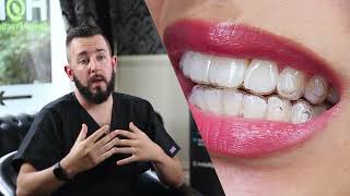 How Invisalign changes your face [upl. by Notsua]