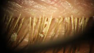 Demodex Mites Removed from Eyelid Eyelashes [upl. by Alleciram915]